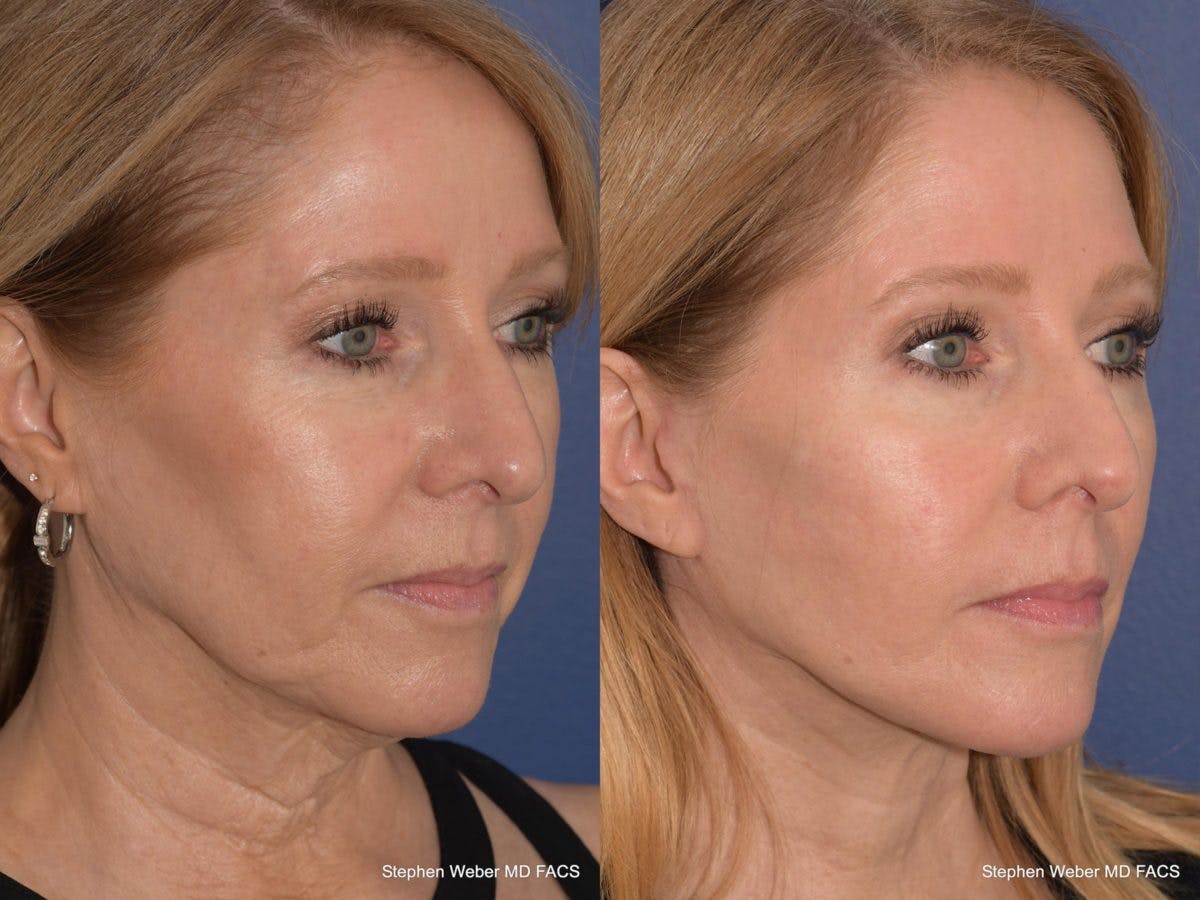 Facelift Before & After Gallery - Patient 330443 - Image 5