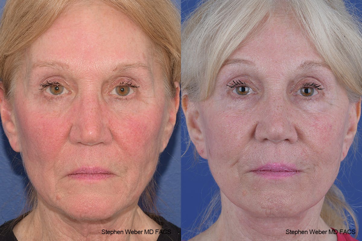 Facelift Before & After Gallery - Patient 309081 - Image 1