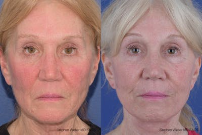 Facelift Before & After Gallery - Patient 309081 - Image 1