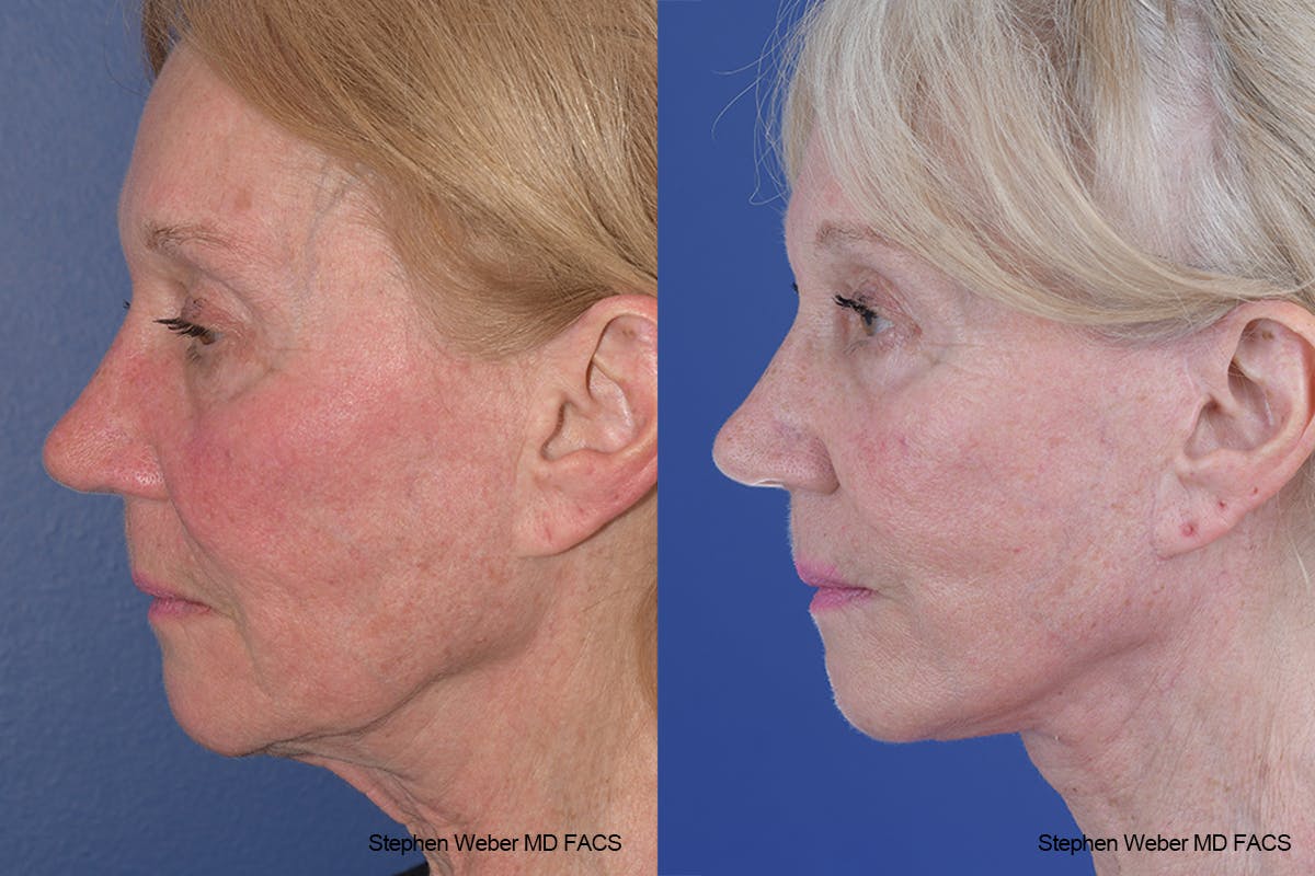 Facelift Before & After Gallery - Patient 309081 - Image 2