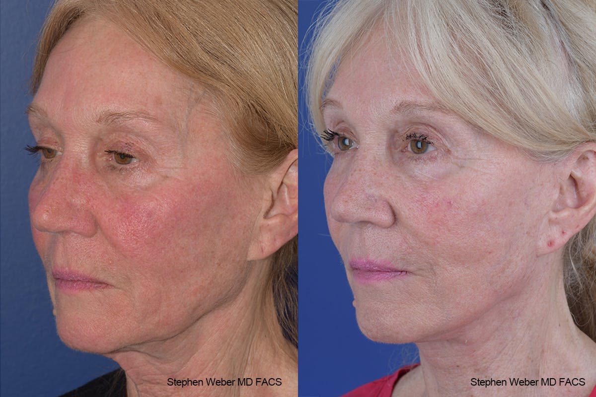 Facelift Before & After Gallery - Patient 309081 - Image 3