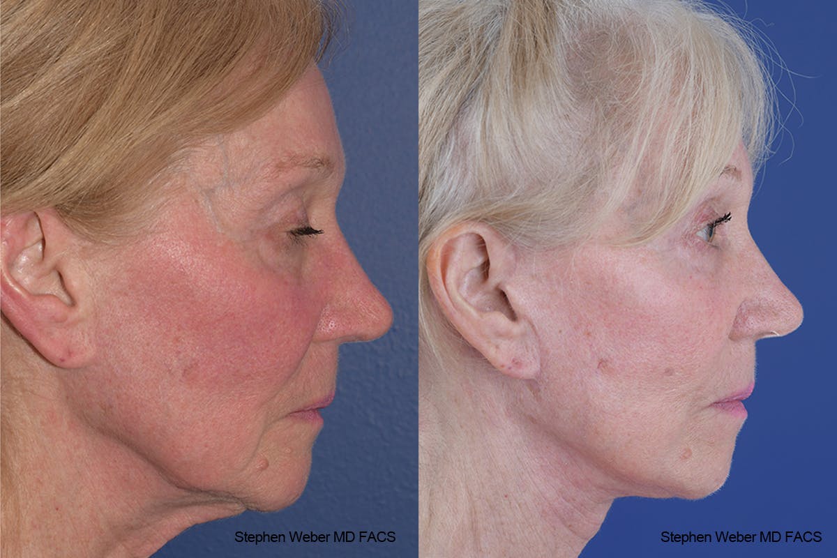 Facelift Before & After Gallery - Patient 309081 - Image 4