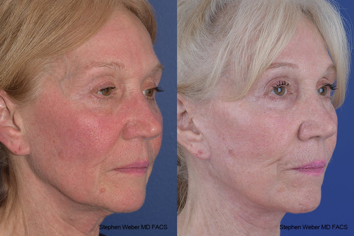 Facelift Before & After Gallery - Patient 309081 - Image 5