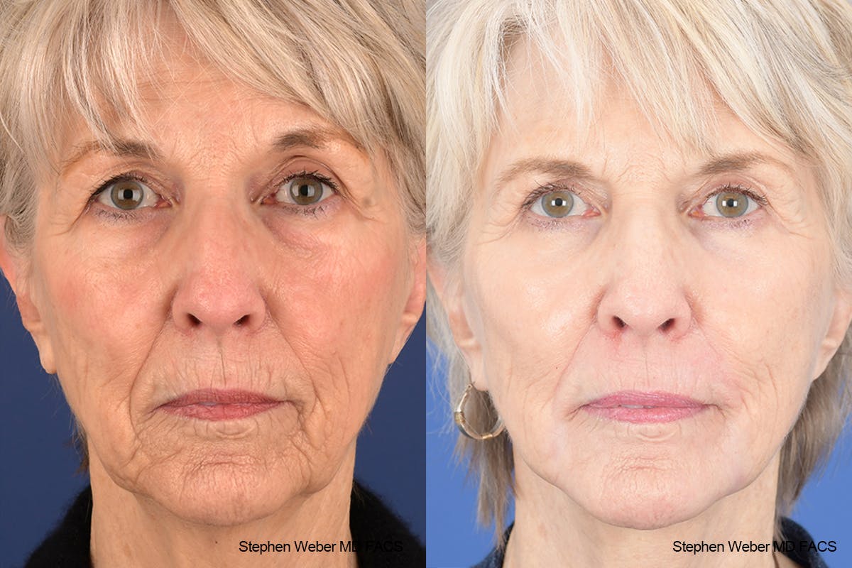 Facelift Before & After Gallery - Patient 299220 - Image 1
