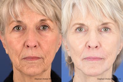 Facelift Before & After Gallery - Patient 299220 - Image 1