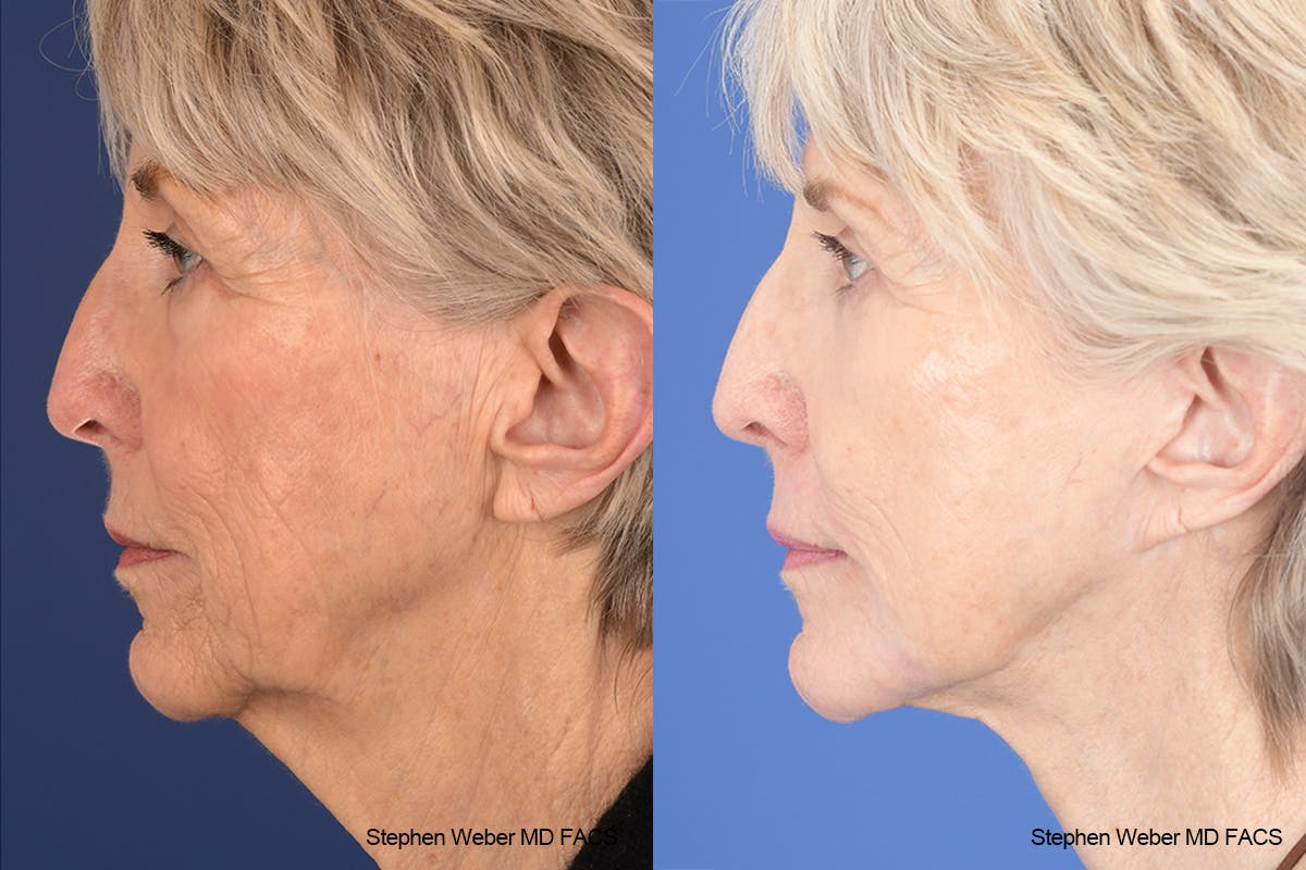 Facelift Before & After Gallery - Patient 299220 - Image 2