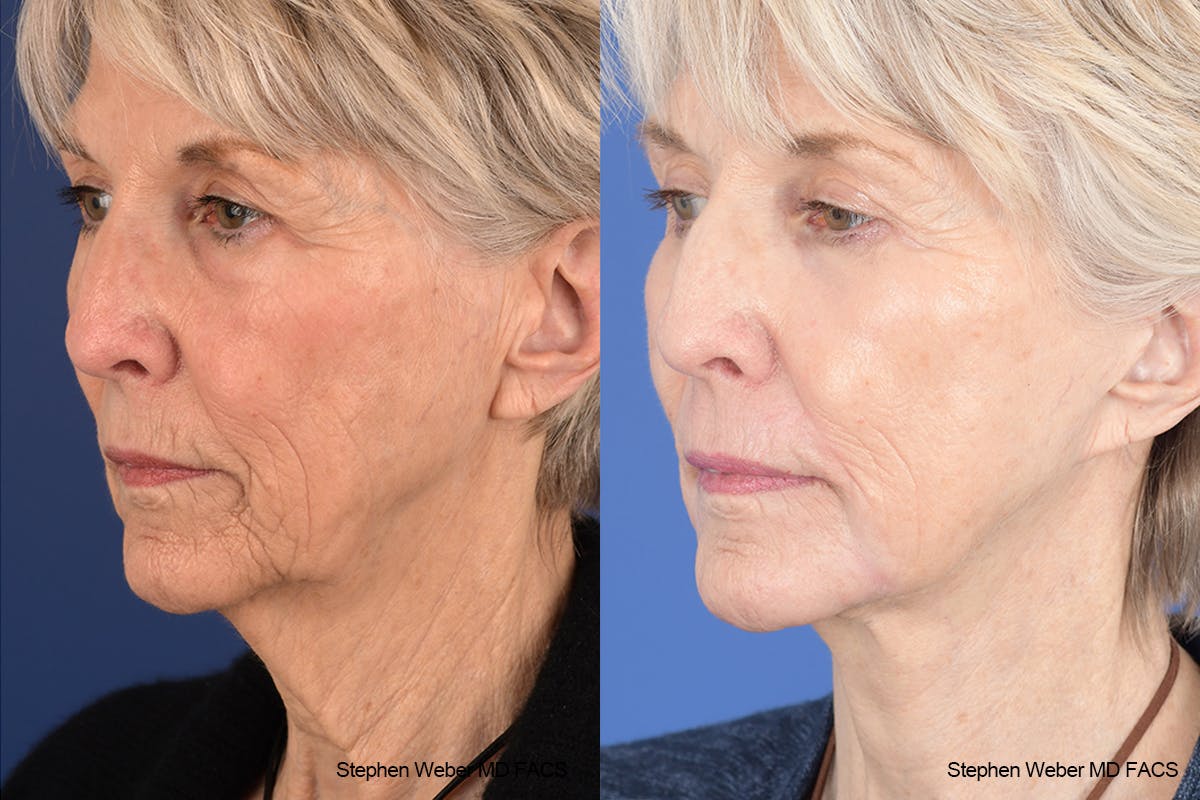 Facelift Before & After Gallery - Patient 299220 - Image 3