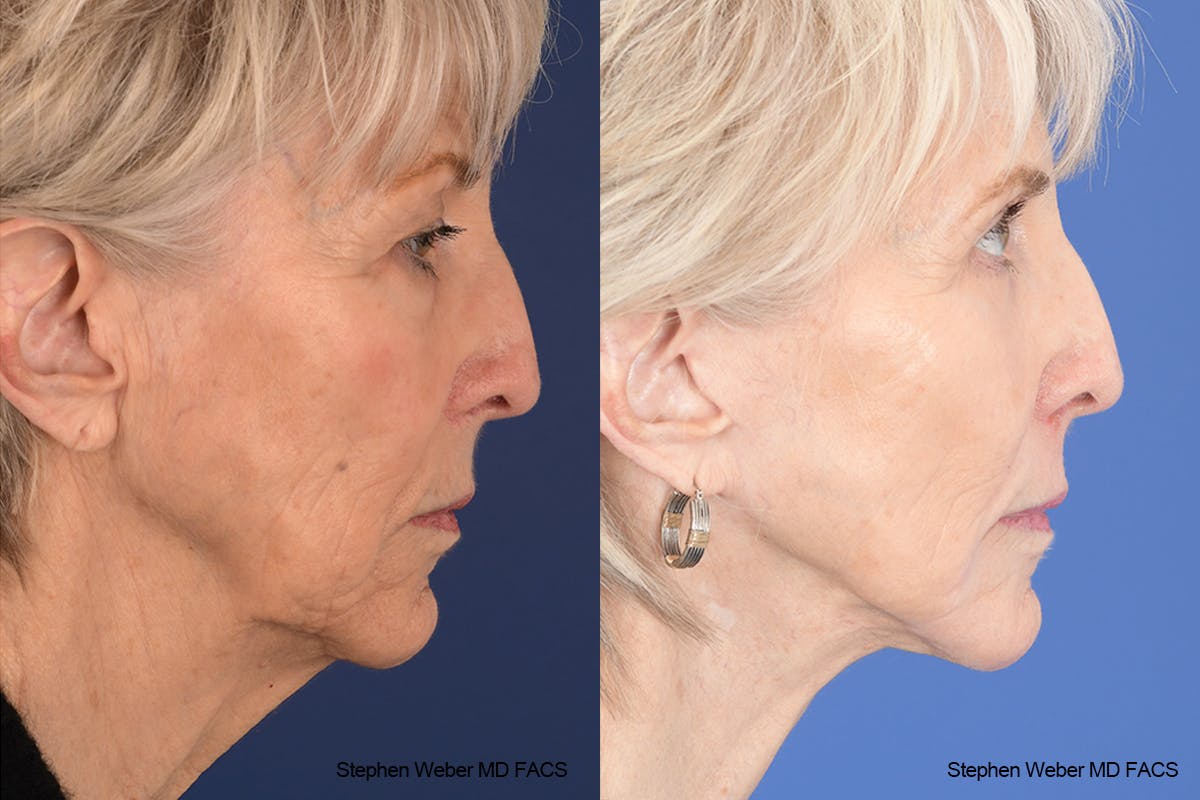 Facelift Before & After Gallery - Patient 299220 - Image 4