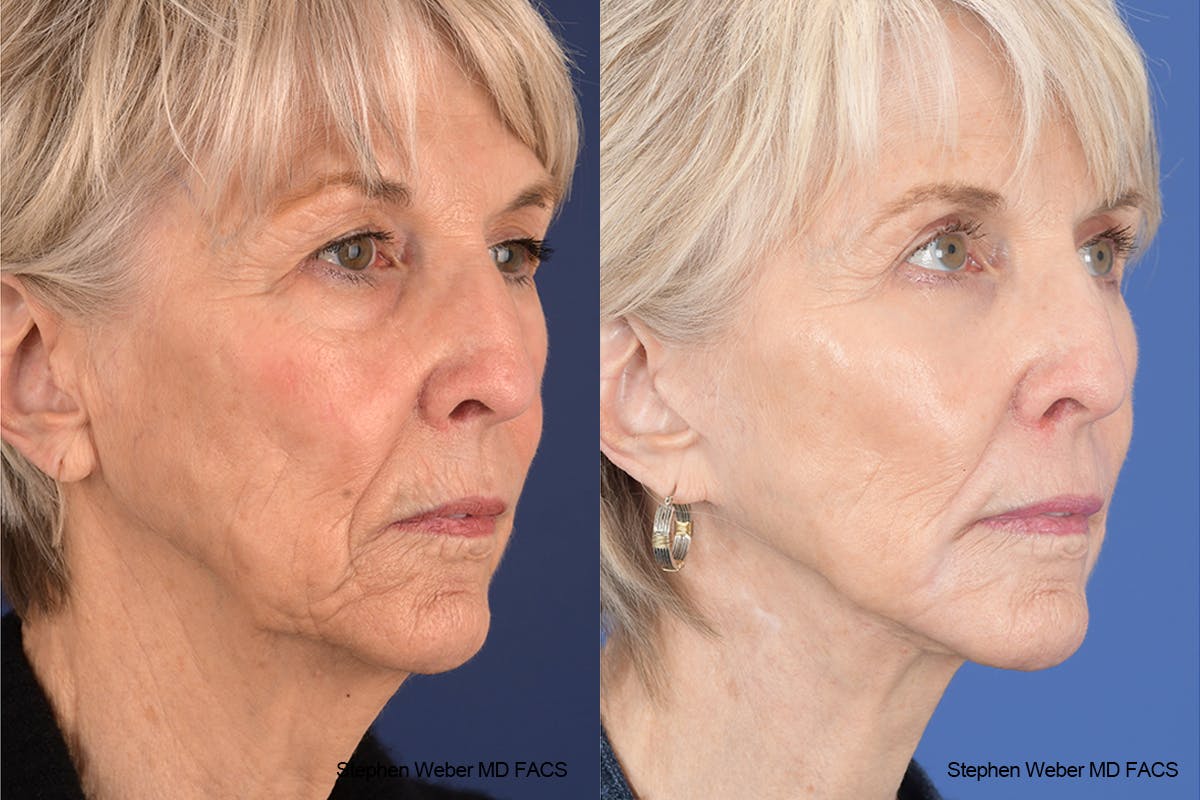 Facelift Before & After Gallery - Patient 299220 - Image 5