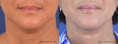 Facelift Before & After Gallery - Patient 352934 - Image 1