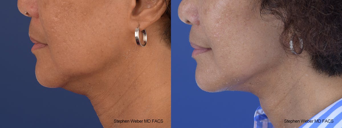 Facelift Before & After Gallery - Patient 352934 - Image 2