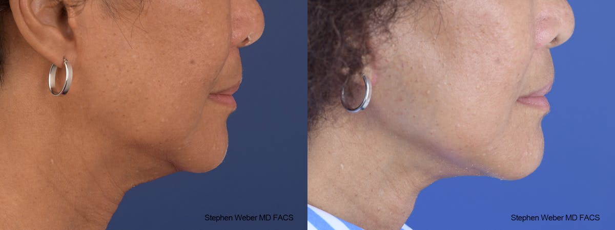 Facelift Before & After Gallery - Patient 352934 - Image 4