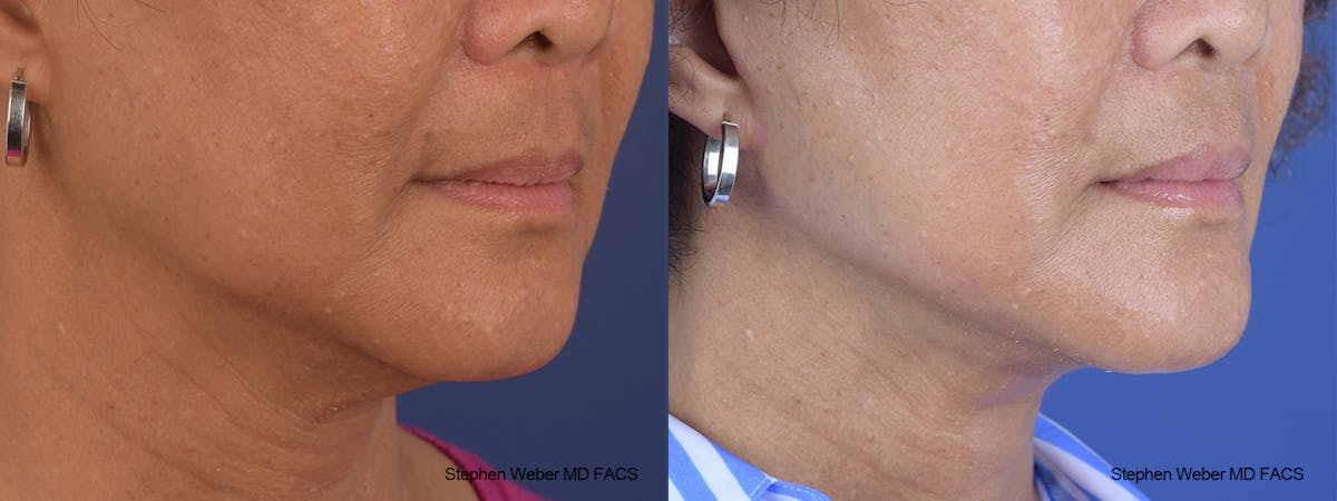 Facelift Before & After Gallery - Patient 352934 - Image 5