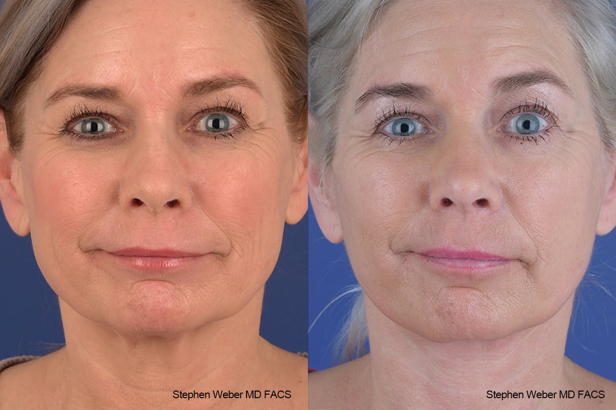 Facelift Before & After Gallery - Patient 682161 - Image 1