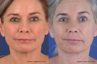 Facelift Before & After Gallery - Patient 682161 - Image 1