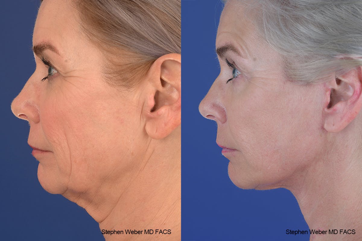 Facelift Before & After Gallery - Patient 682161 - Image 2
