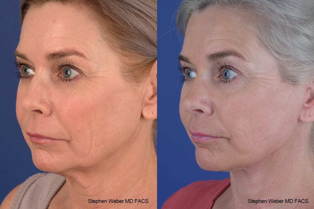 Facelift Before & After Gallery - Patient 682161 - Image 3