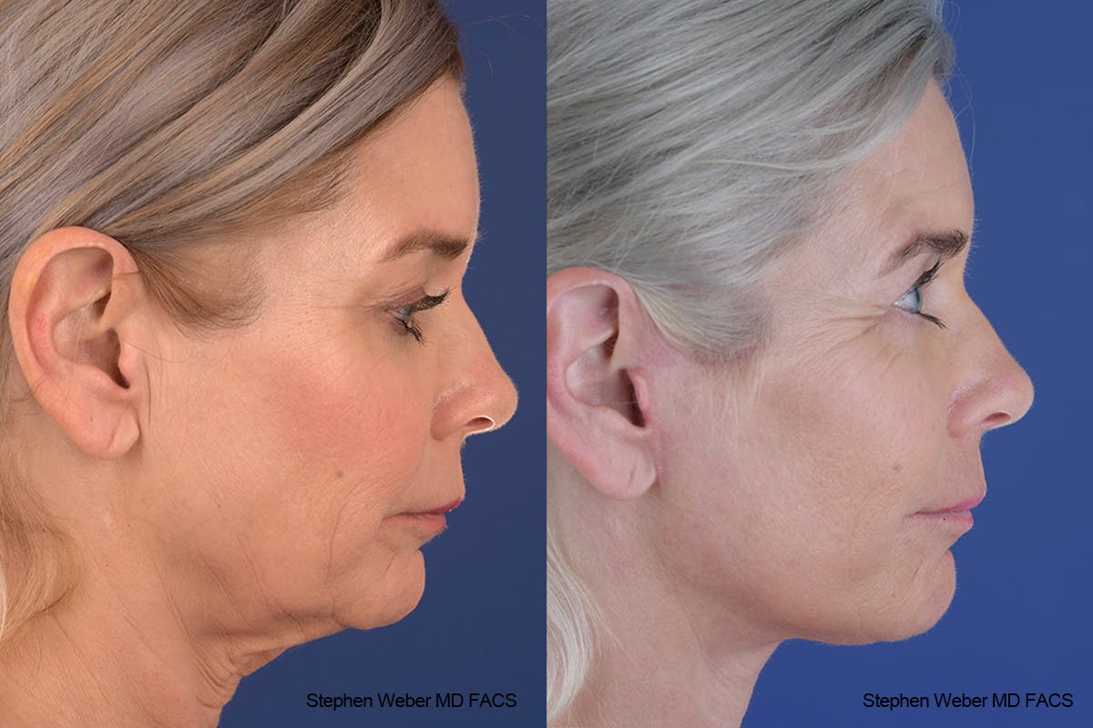 Facelift Before & After Gallery - Patient 682161 - Image 4