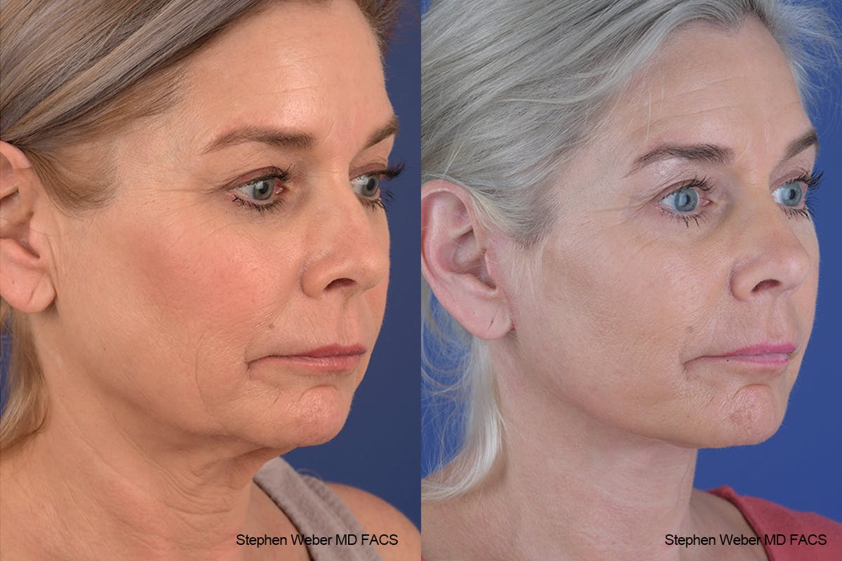 Facelift Before & After Gallery - Patient 682161 - Image 5