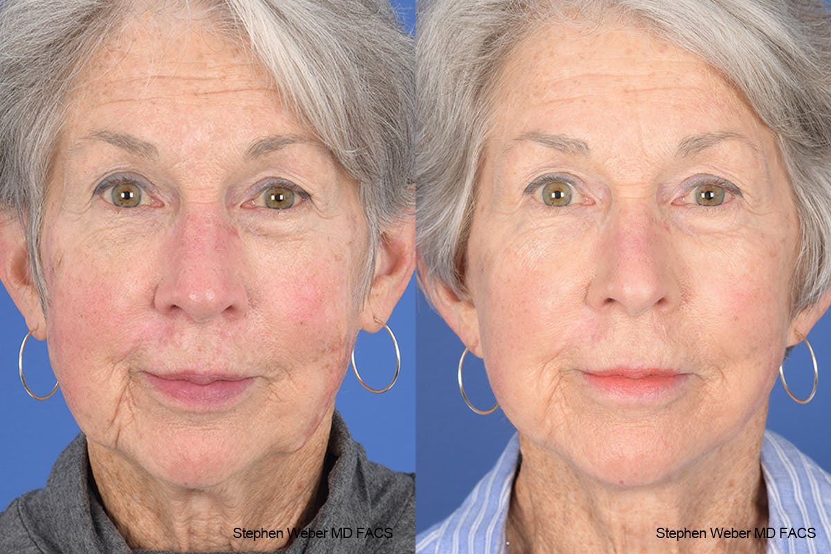 Facelift Before & After Gallery - Patient 255387 - Image 1