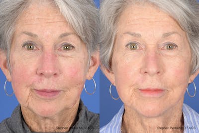 Facelift Before & After Gallery - Patient 255387 - Image 1