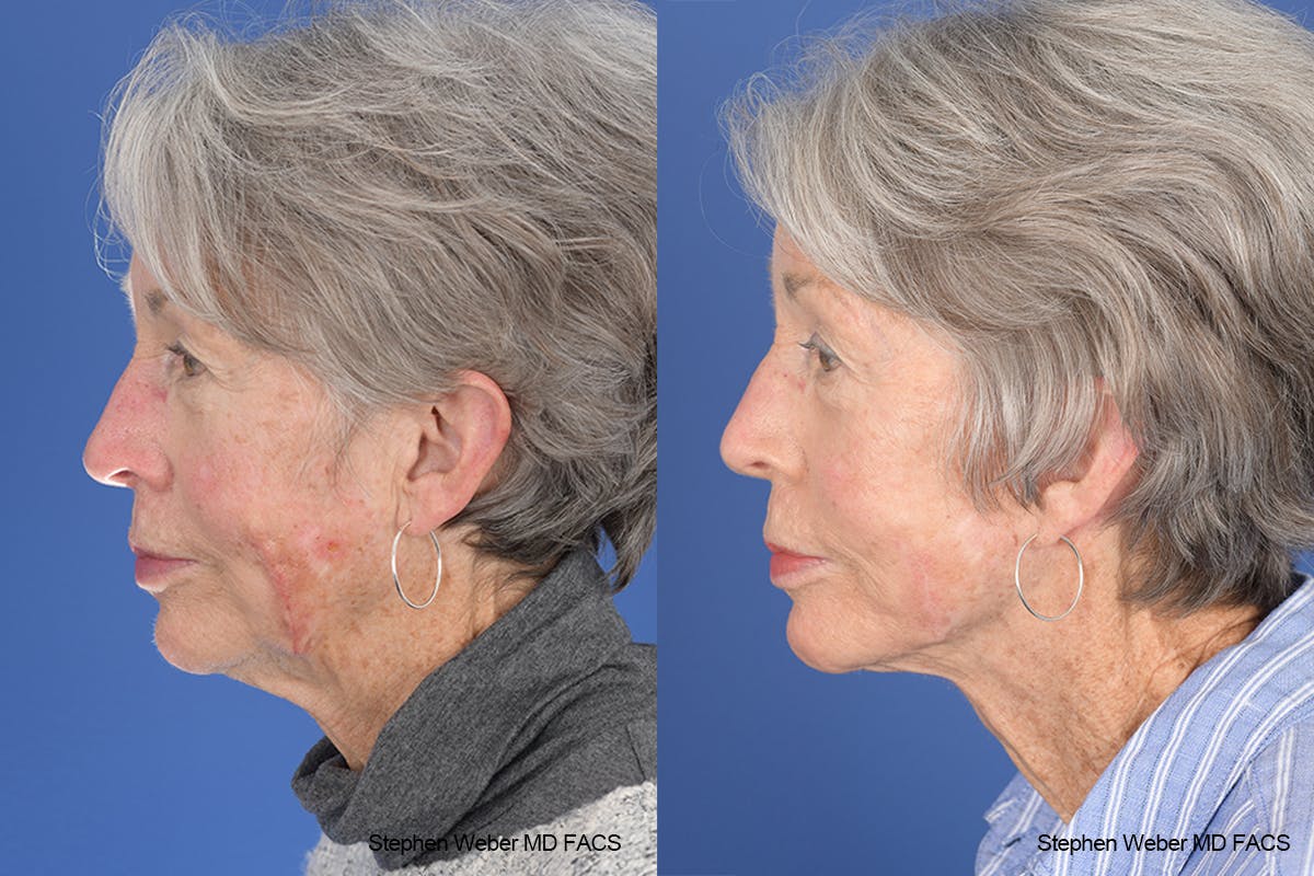Facelift Before & After Gallery - Patient 255387 - Image 2