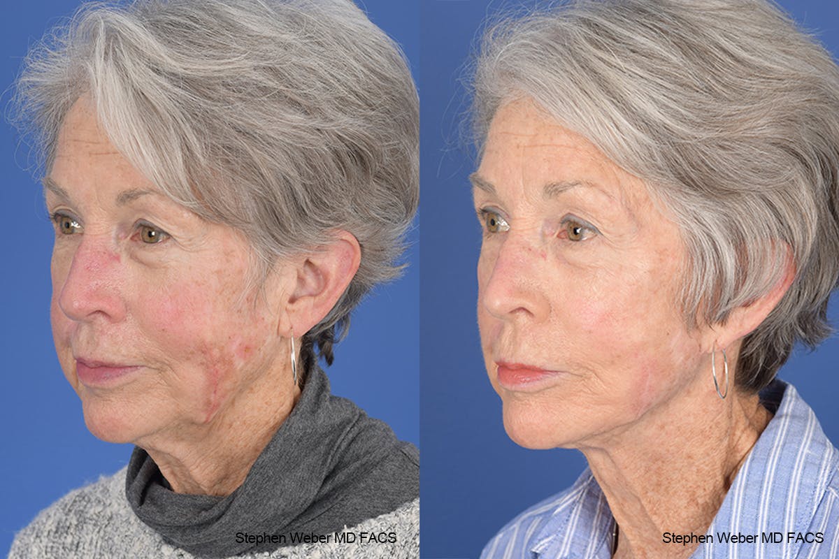 Facelift Before & After Gallery - Patient 255387 - Image 3