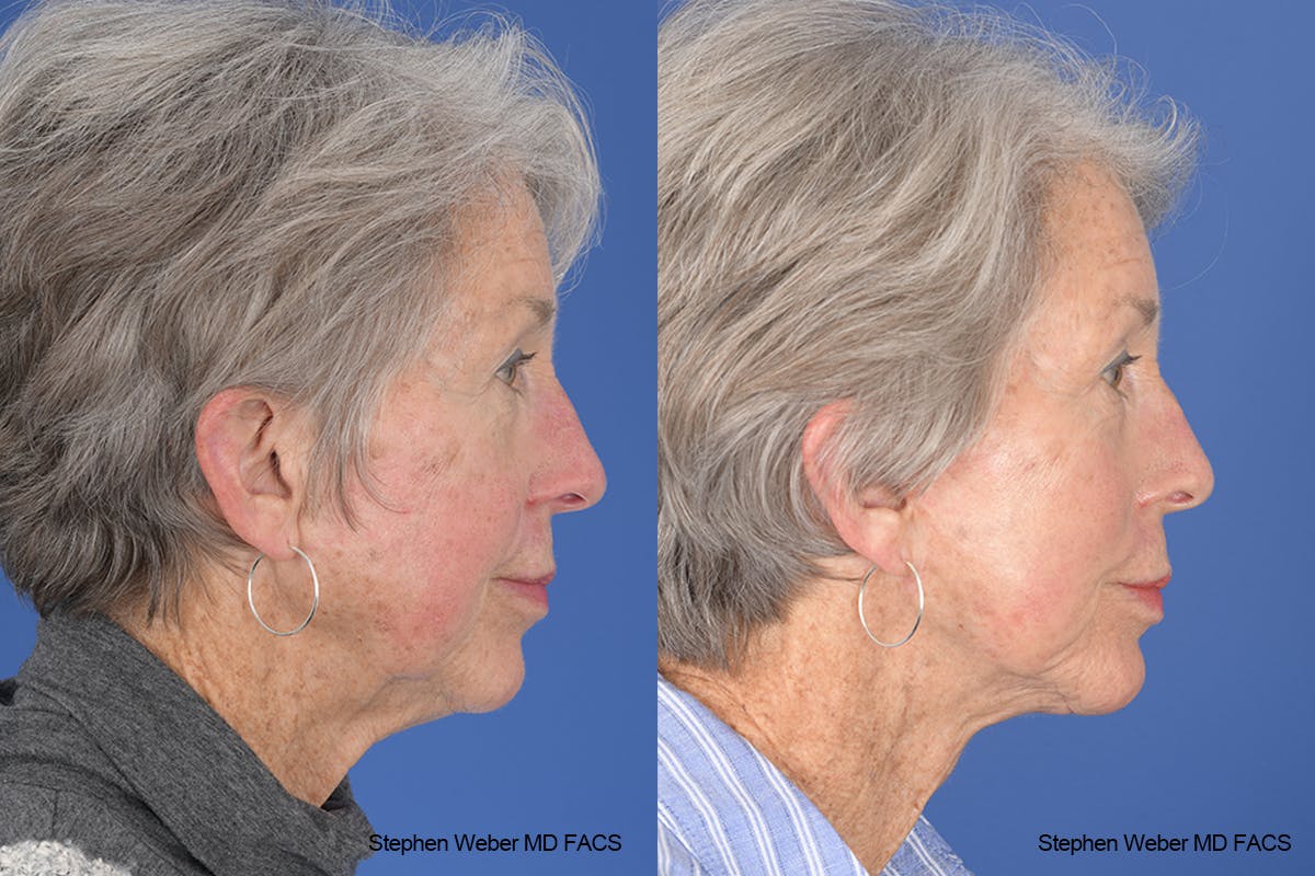 Facelift Before & After Gallery - Patient 255387 - Image 4