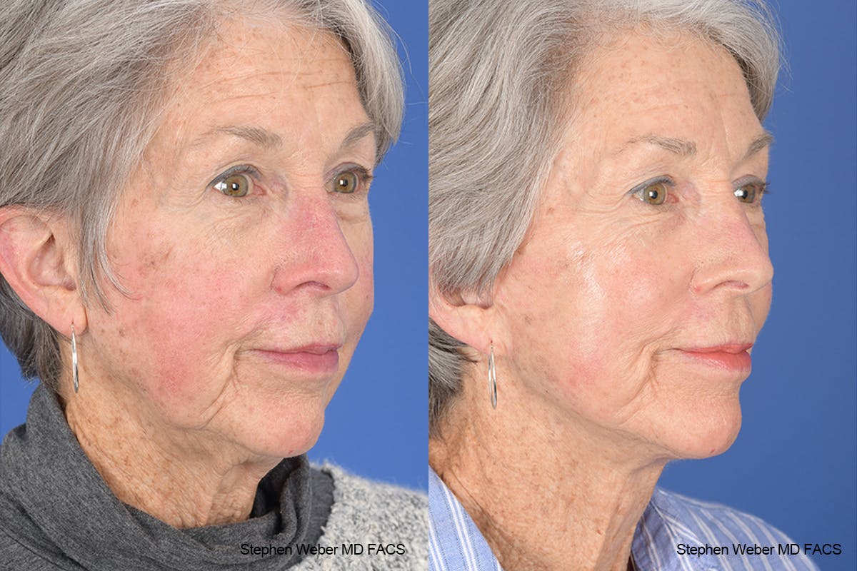 Facelift Before & After Gallery - Patient 255387 - Image 5