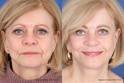 Facelift Before & After Gallery - Patient 238974 - Image 1