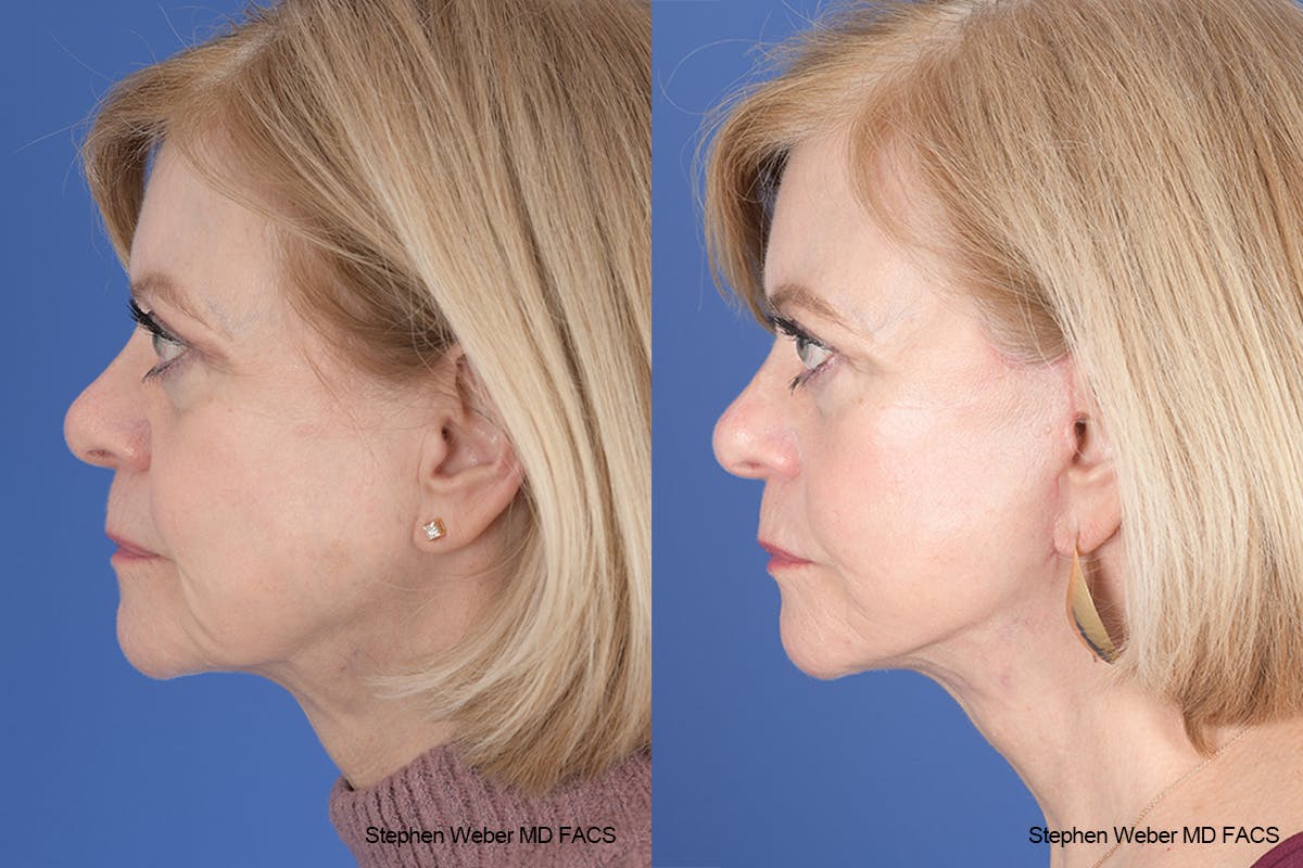 Facelift Before & After Gallery - Patient 238974 - Image 2