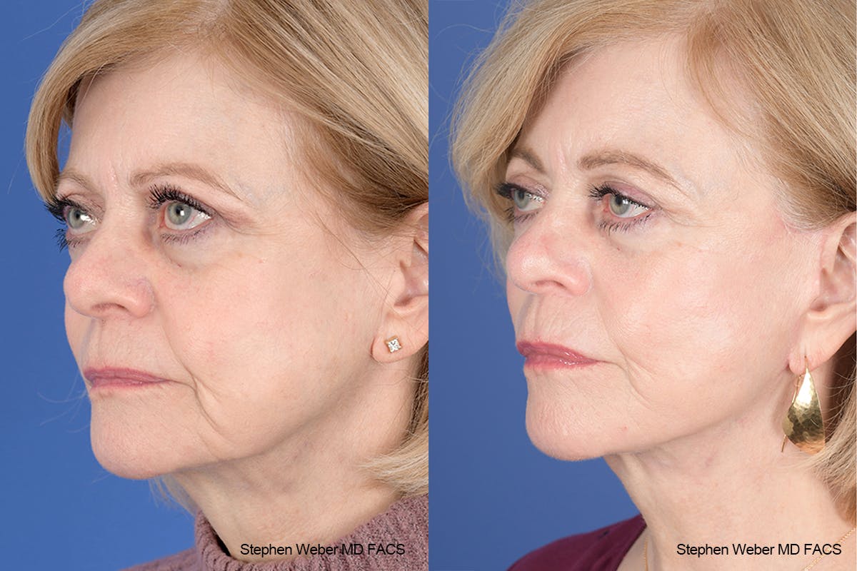 Facelift Before & After Gallery - Patient 238974 - Image 3