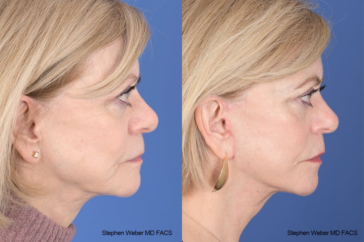 Facelift Before & After Gallery - Patient 238974 - Image 4