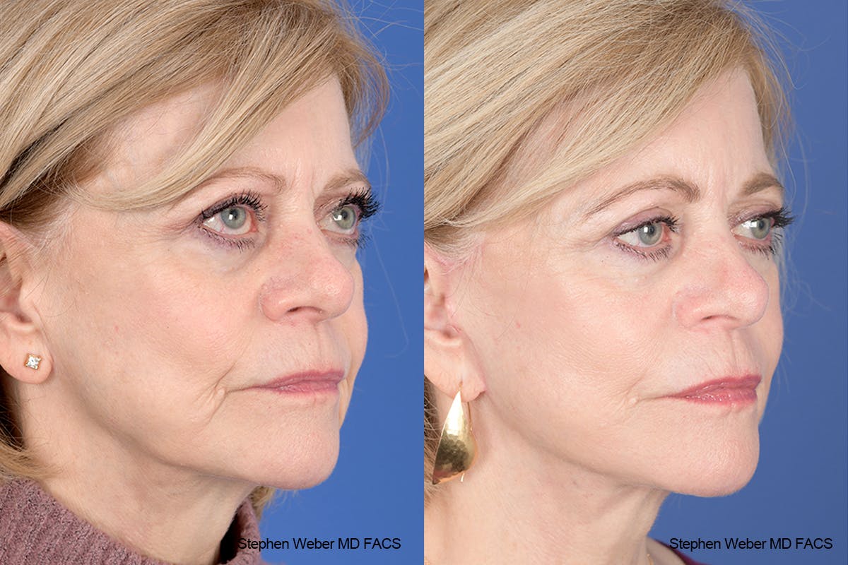 Facelift Before & After Gallery - Patient 238974 - Image 5
