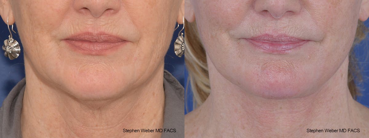 Facelift Before & After Gallery - Patient 164692 - Image 1