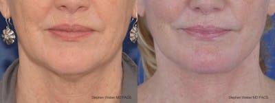 Facelift Before & After Gallery - Patient 164692 - Image 1