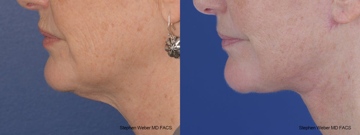 Facelift Before & After Gallery - Patient 164692 - Image 2