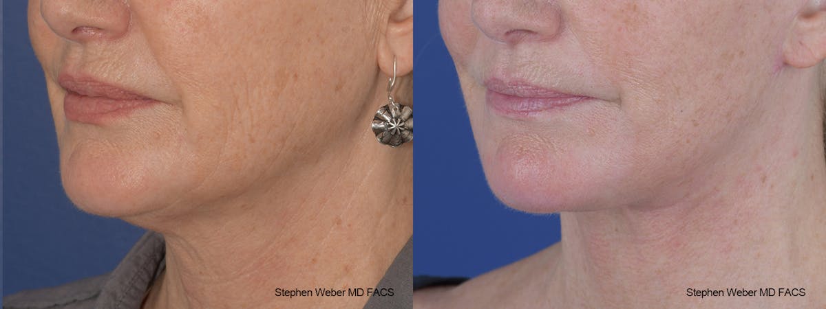 Facelift Before & After Gallery - Patient 164692 - Image 3