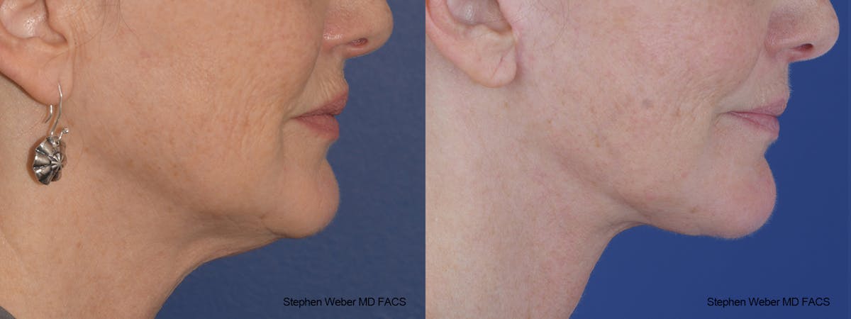 Facelift Before & After Gallery - Patient 164692 - Image 4