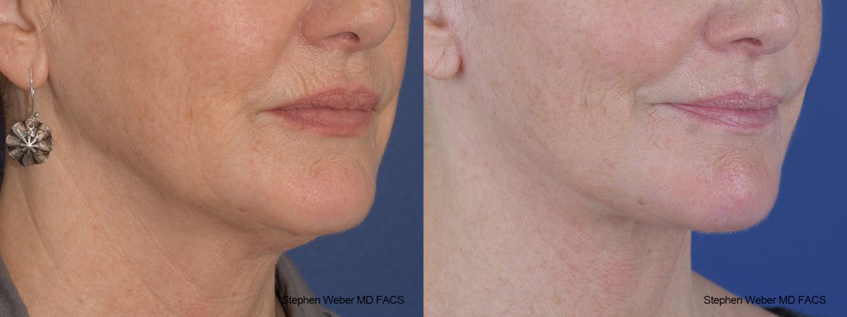 Facelift Before & After Gallery - Patient 164692 - Image 5