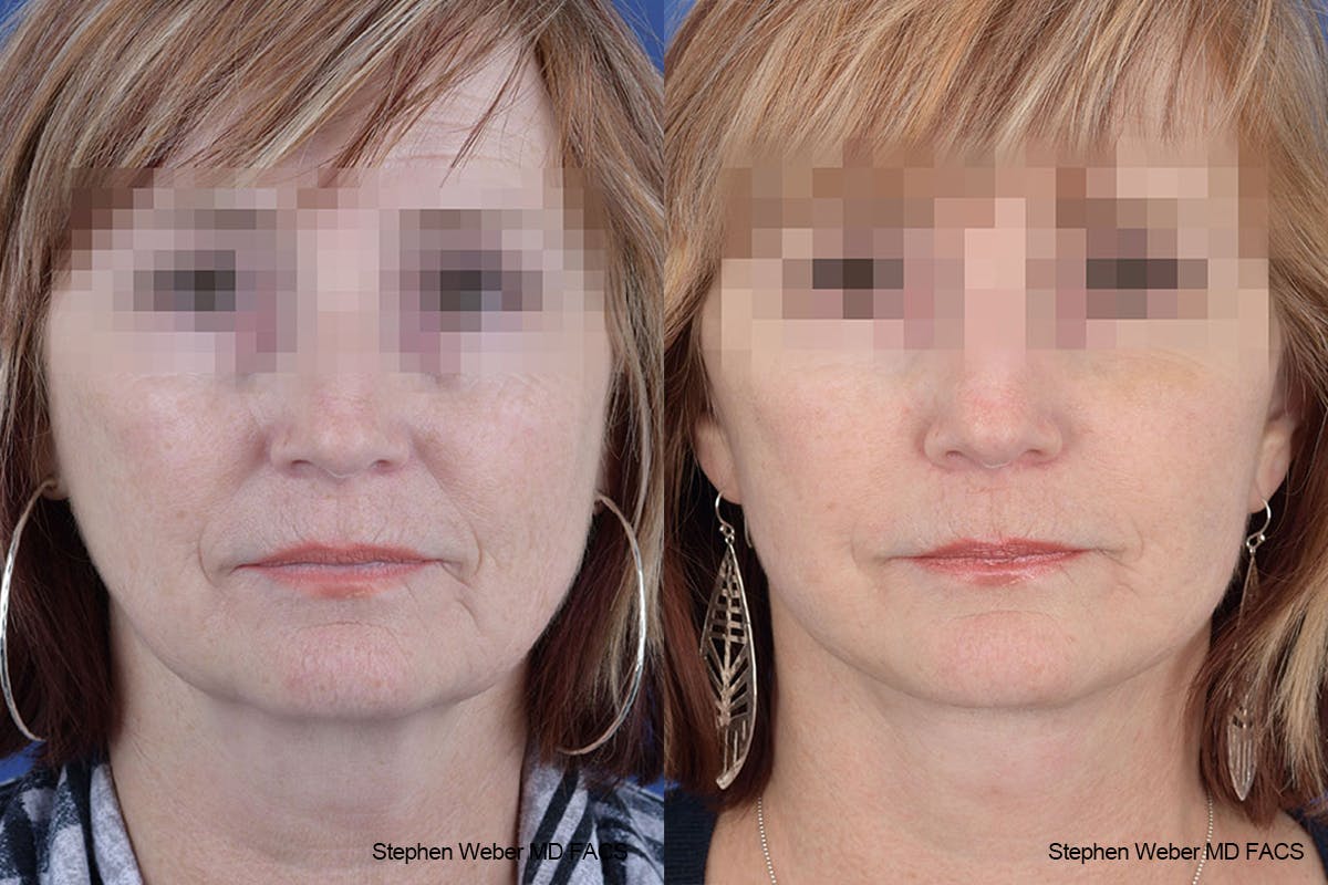 Facelift Before & After Gallery - Patient 125578 - Image 1