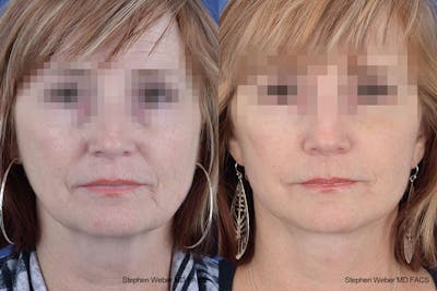 Facelift Before & After Gallery - Patient 125578 - Image 1