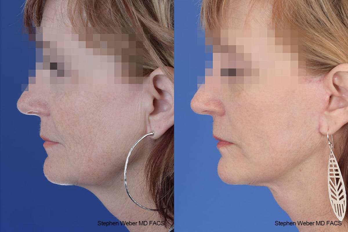 Facelift Before & After Gallery - Patient 125578 - Image 2