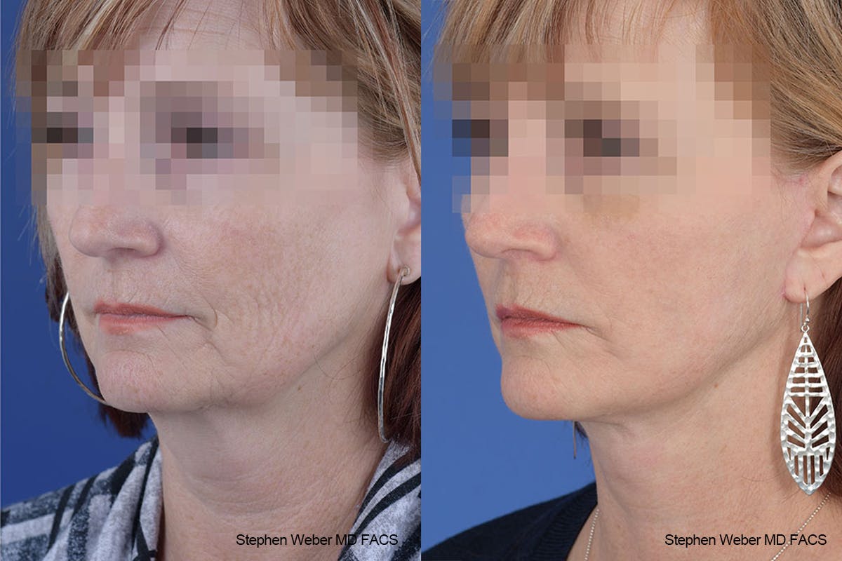 Facelift Before & After Gallery - Patient 125578 - Image 3