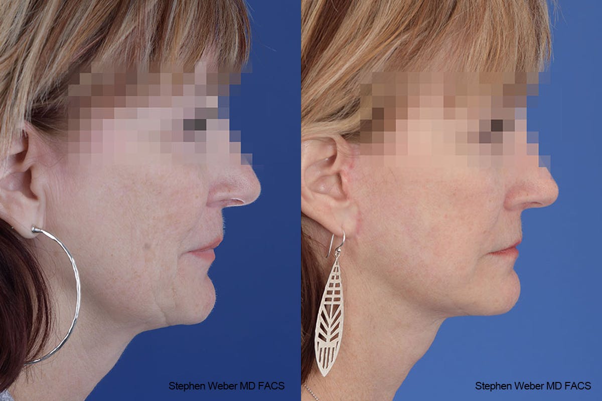 Facelift Before & After Gallery - Patient 125578 - Image 4