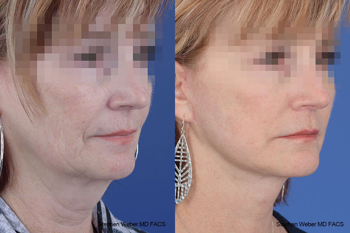 Facelift Before & After Gallery - Patient 125578 - Image 5