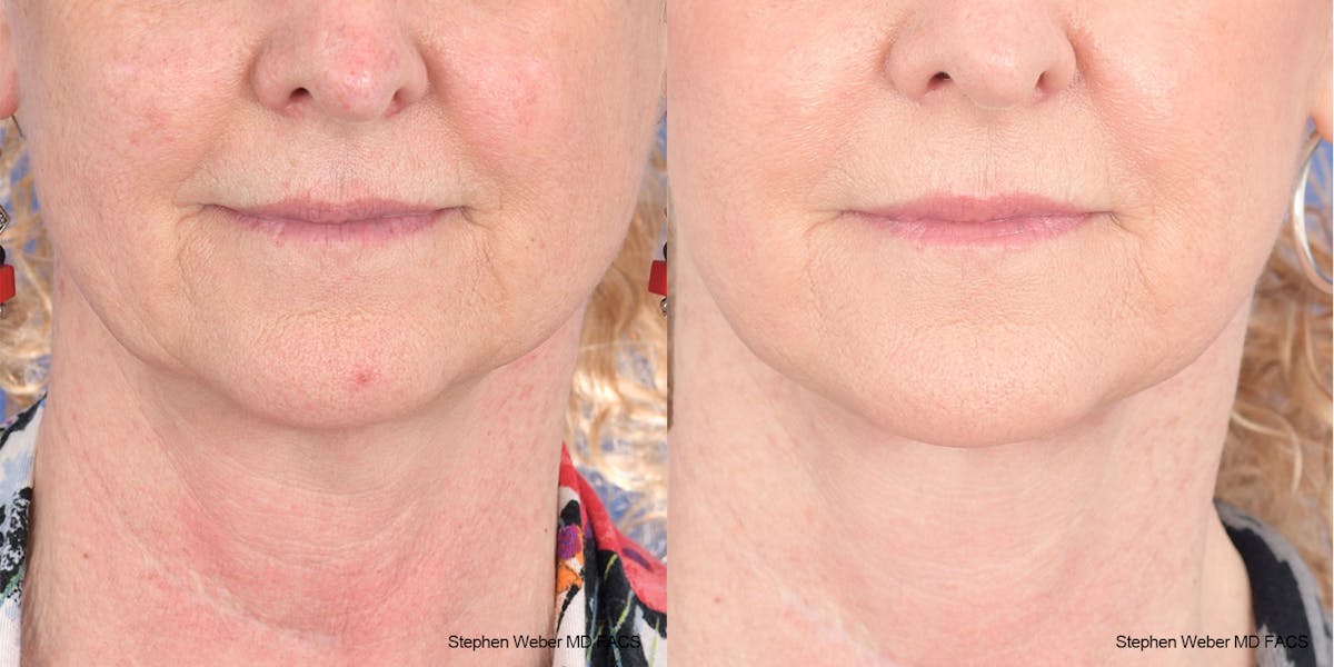 Facelift Before & After Gallery - Patient 208838 - Image 1