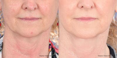 Facelift Before & After Gallery - Patient 208838 - Image 1