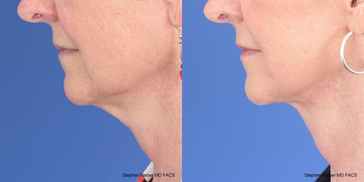 Facelift Before & After Gallery - Patient 208838 - Image 2