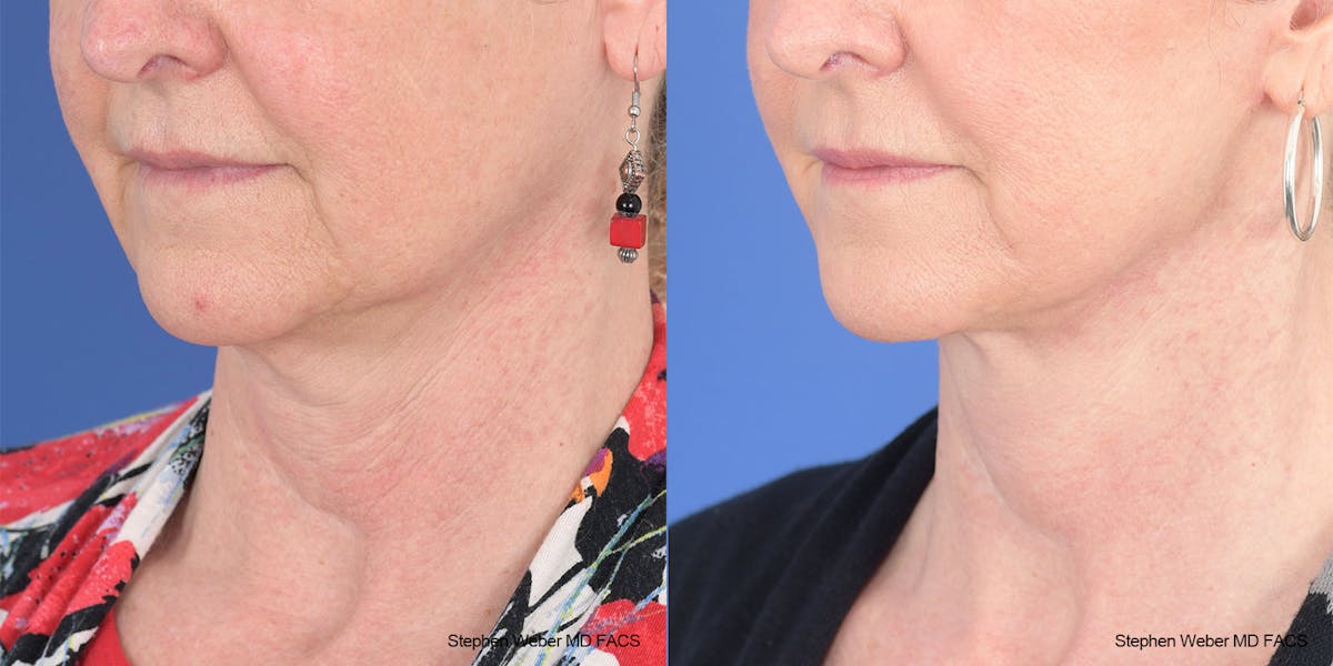 Facelift Before & After Gallery - Patient 208838 - Image 3